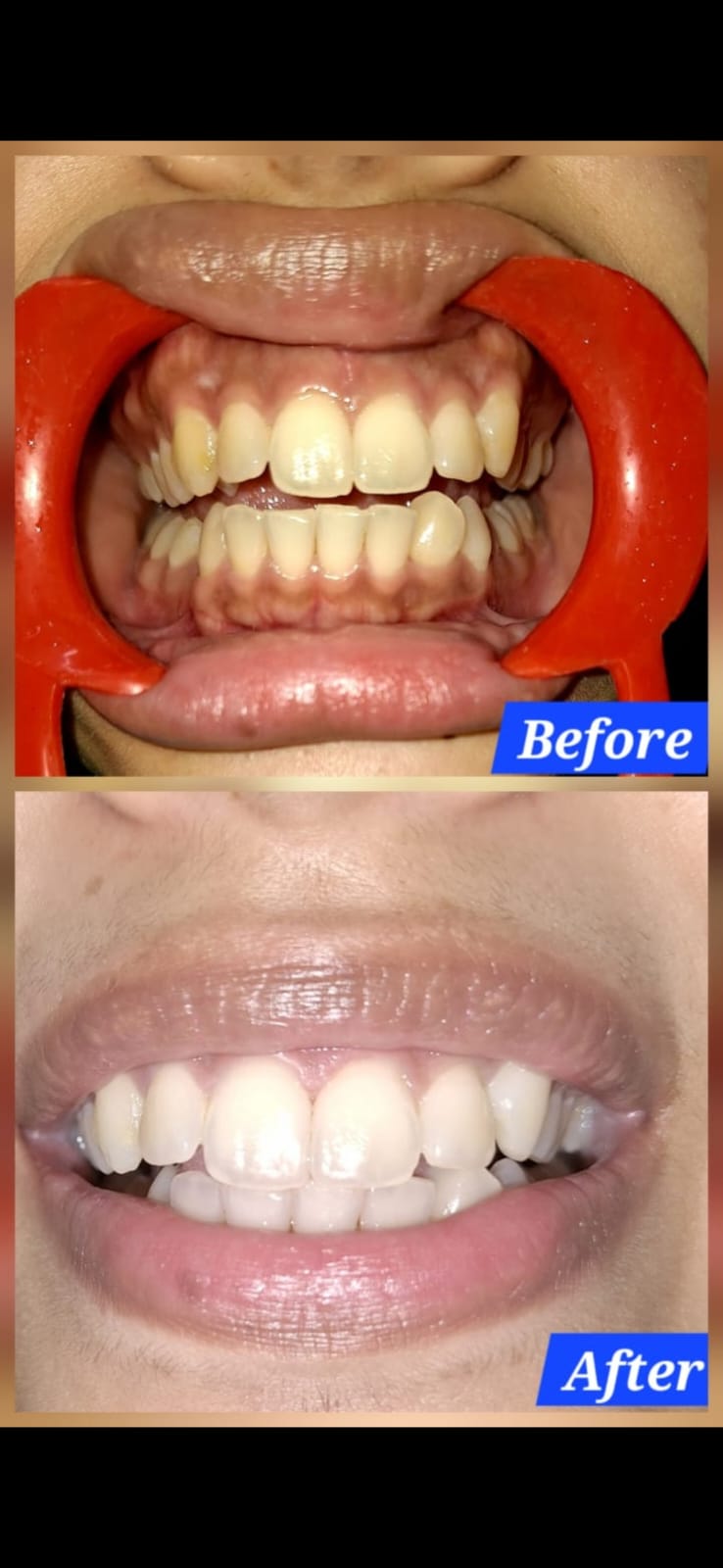 Before or after image - REPLACE_ME